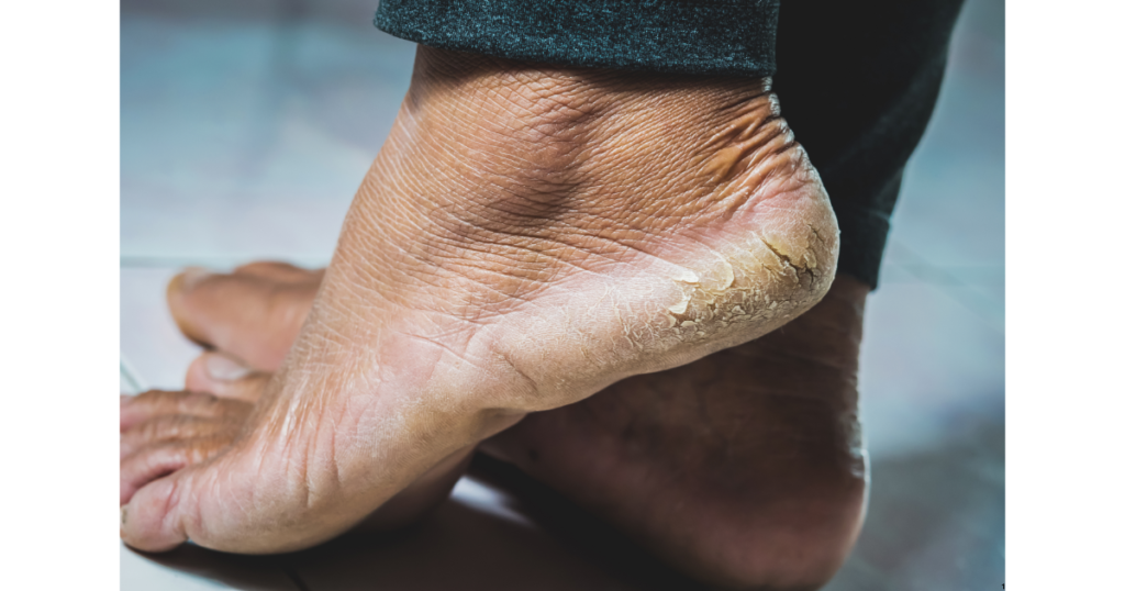 Recetas caseras naturales para tratar los pies agrietados