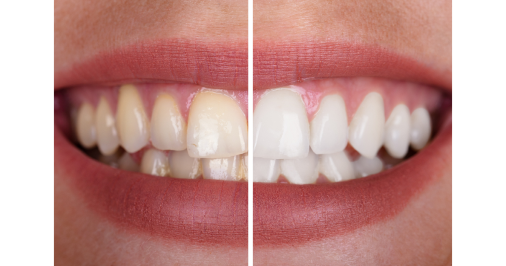 Recetas Naturales para Blanquear los Dientes: ¡Consigue una Sonrisa Radiante en Casa!